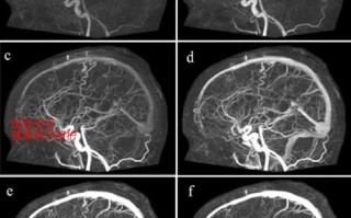 有关人工智能在ct血管