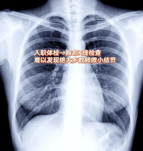 AI读片肺结节过度诊断怎么办？-第1张图片-广州国自机器人