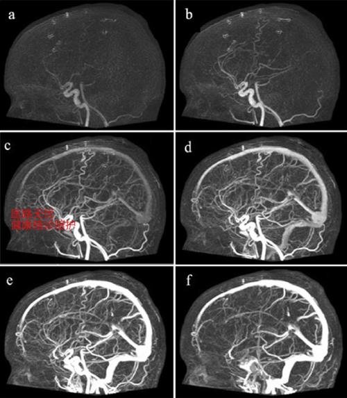 有关人工智能在ct血管-第1张图片-广州国自机器人