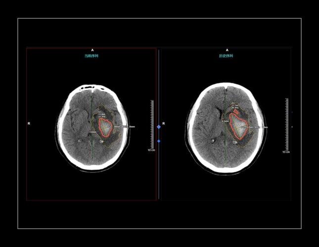 有关人工智能在ct血管-第3张图片-广州国自机器人