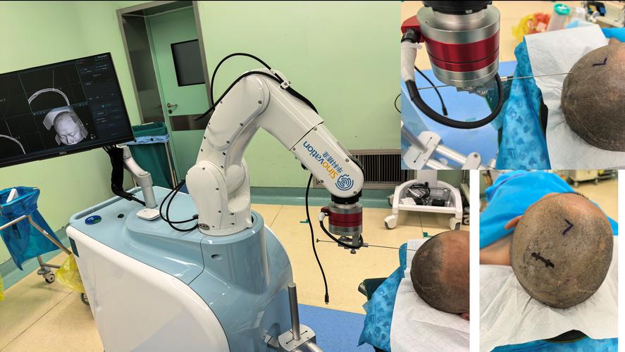 机器人做手术安全吗？-第2张图片-广州国自机器人