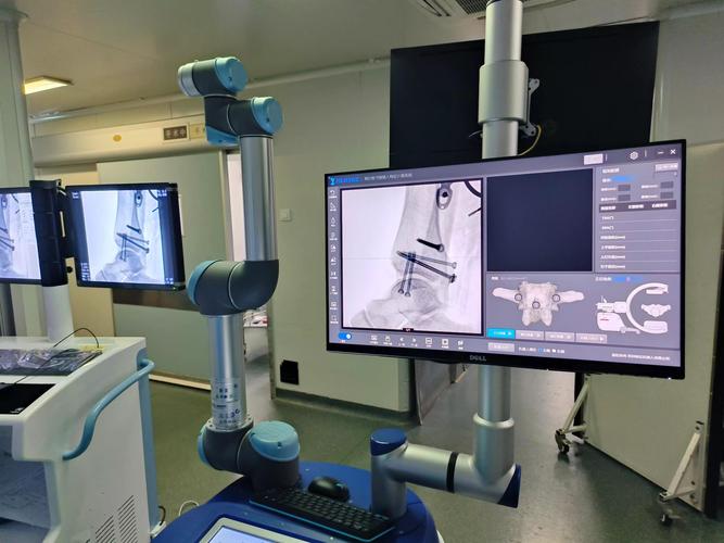 骨科手术机器人公司有何技术优势？-第2张图片-广州国自机器人